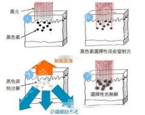 重庆西南医院激光祛斑结果怎样呢？