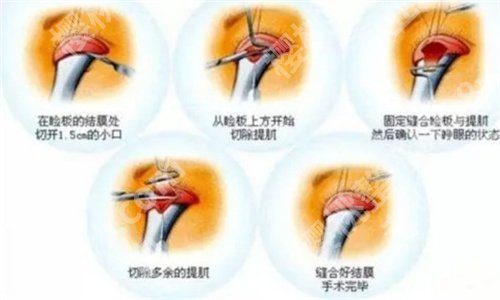 南京省中医院去眼袋怎么样？在线爱预览技术点评