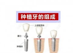 深圳同步齿科种植牙多少钱一颗？2024年价格表更新，相关案例介绍