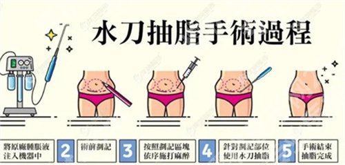 济南市中心医院抽脂技术怎么样？看用户真实反馈