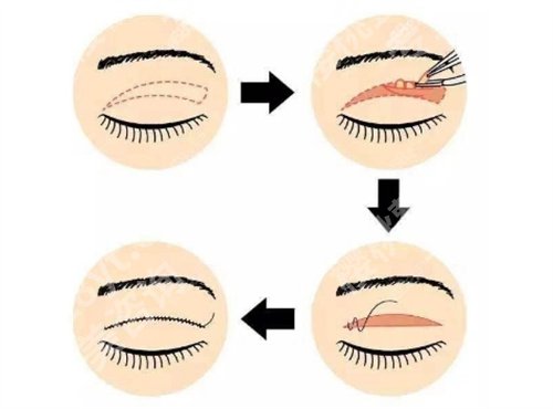 陈孟春双眼皮做怎么样？医生技术实力在线，一文探索