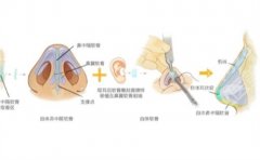 深圳美莱做鼻子谁好？医院实力曝光，一文探索