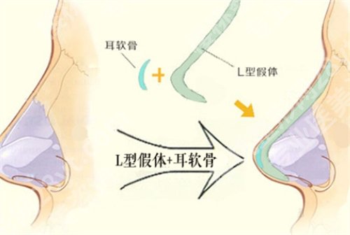 深圳美莱做鼻子谁好？医院实力曝光，一文探索