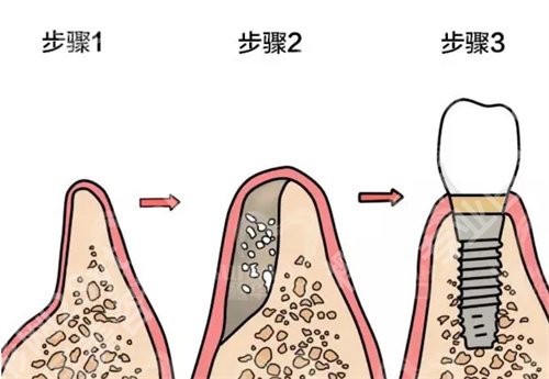 广州穗华口腔医院种牙怎么样？医院简介，项目推荐