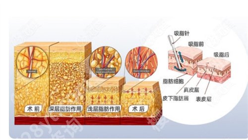 深圳曹孟君医疗怎么样？术后小tips一览