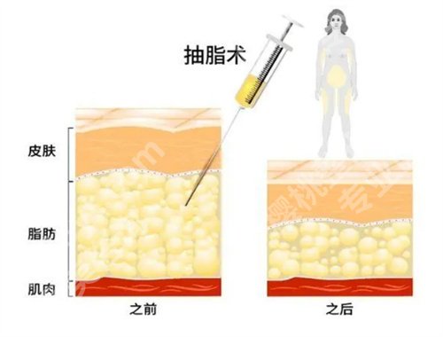 深圳曹孟君医疗怎么样？术后小tips一览