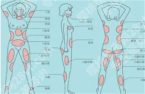 深圳万芸抽脂案例怎么样？抽脂案例分析，技术点评