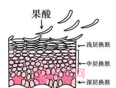 果酸换肤一辈子一直都要做吗？果酸换肤是什么原理？术后注意事项分享！