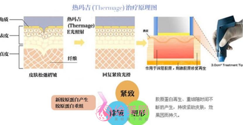 热玛吉除皱果好不好？热玛应人群和禁忌人群有哪些？