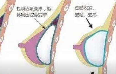 北京假体丰胸案例分享！三个月的蜕变豆包变面包，不信戳进来看看！