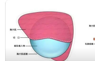 北京假体丰胸案例分享！三个月的蜕变豆包变面包，不信戳进来看看！