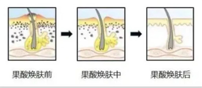 果酸焕肤的果怎么样？真人案例分享！肌肤透亮，有光泽！