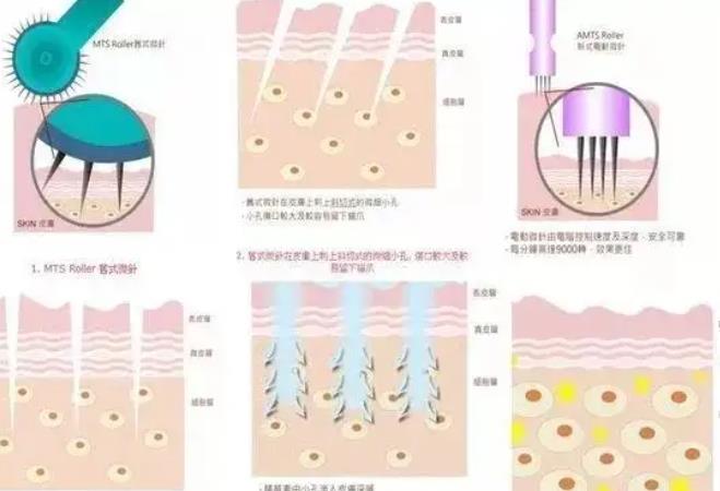 注射胶原蛋白的作用是什么？做完注射之后需要注意哪些事情？