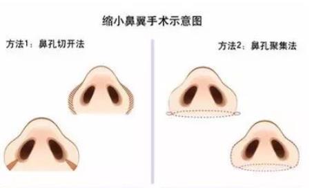 鼻翼缩小有几种方法？鼻翼缩小手术风险大吗？注意事项分享
