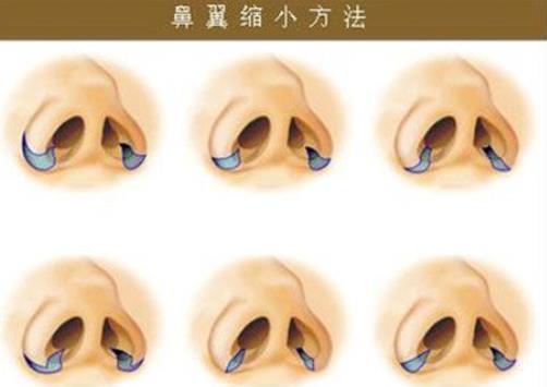 鼻翼缩小有几种方法？鼻翼缩小手术风险大吗？注意事项分享