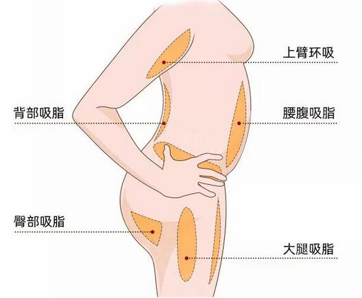 局部吸脂减肥创伤大不大？减肥后的注意事项有哪些？