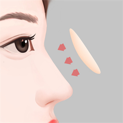 耳软骨隆鼻好还是假体？耳软骨隆鼻的优势有哪些？