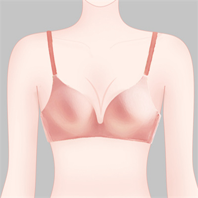 假体隆胸术有哪些特点?内附隆胸的注意事项分享！