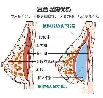 自体隆胸手术失败修复注意事项有哪些？这些细节你知道吗？