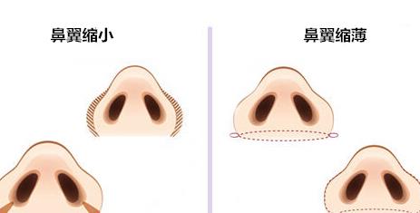注射胶原蛋白隆鼻的价格是多少？注射隆鼻原理是什么？影响因素分享