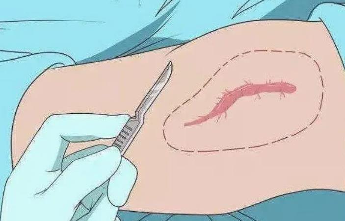 疤痕修复手术一般多少钱？手术方法有哪些？注意事项分享