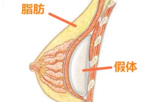 隆胸手术前后对比果图曝光！胸部整形选择什么方式比较好？