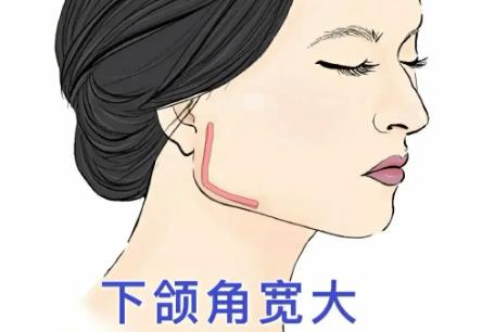 下颌骨整形价钱贵吗？做下颌角整形手术需要注意哪些事情？