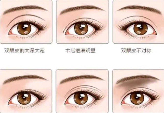 北京华韩医疗美容医院怎么样？医院特色项目及双眼皮的切割果分享