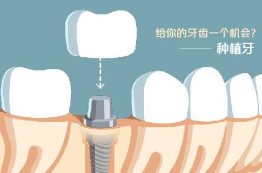 种牙价格多少钱一颗牙齿？影响价格的因素有哪些？