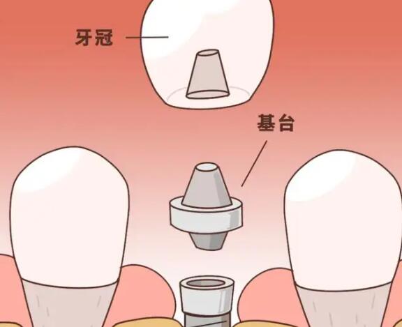 种牙价格多少钱一颗牙齿？影响价格的因素有哪些？