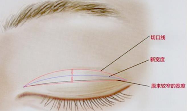 西安汉唐传承做双眼皮咋样？真人眼部整形案例图分享！手术期间注意事项分享