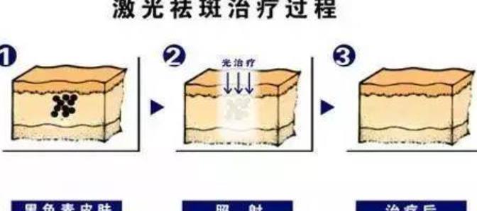 复光祛斑价格贵吗？复光祛斑的果好不好？价格多少？