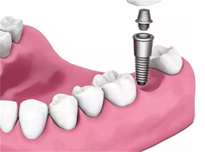 种植牙的五大危害，缺失牙术前必备了解知识！