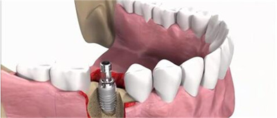 种植牙的五大危害，缺失牙术前必备了解知识！