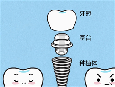 种植满口牙需多少钱？价格范围公布！