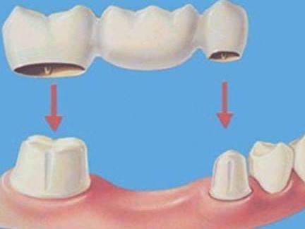 门牙烤瓷牙多少钱？价格受到哪些因素，看分析？