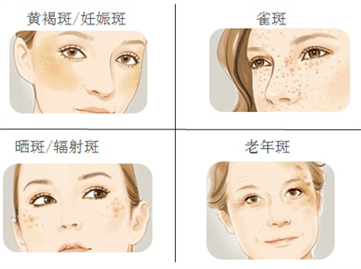 光子嫩肤能祛斑吗？预期效果如何？是否有效？
