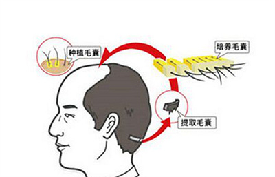 植发手术痛不痛？有着多少痛苦？一并了解！