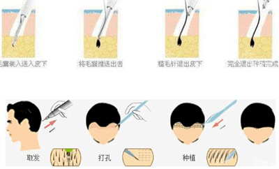 植发手术痛不痛？吗？免受“秃顶”困扰！