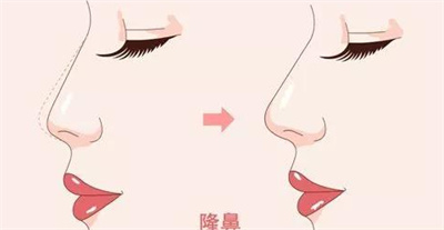 玻尿酸隆鼻手术费用是多少，影响价格具体因素带来介绍！