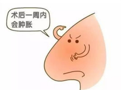 膨体材料隆鼻多少钱？影响价格因素4点阐述