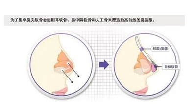 软骨隆鼻需多少钱？价格受到哪些影响呢！