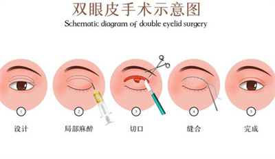 双眼皮手术恢复时间是多少？看双眼皮的科普知识点！