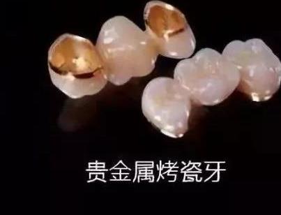成都烤瓷牙价格多少钱？费用大概是多少来看介绍！