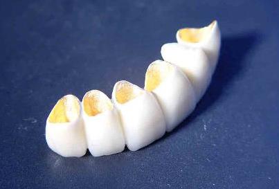 金钯烤瓷牙价格多少钱？阐述几大优点！