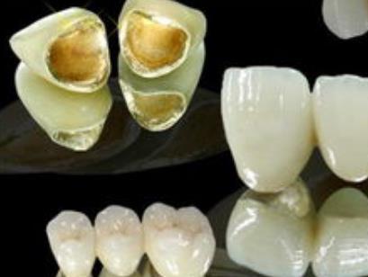 金钯烤瓷牙价格多少钱？阐述几大优点！