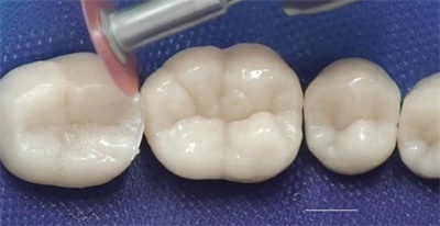 去医院补牙要多少钱？受什么因素影响具体了解？