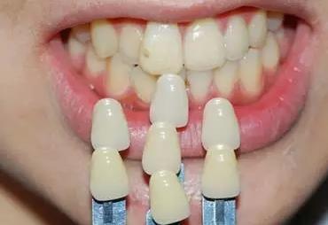 全套烤瓷牙多少钱？了解费用介绍