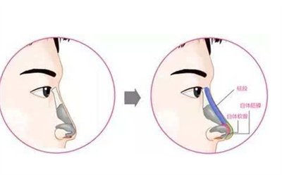 隆鼻手术的价格受哪些影响？具体介绍