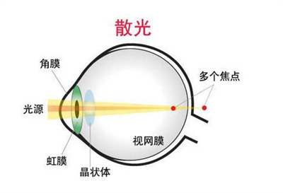 激光手术调节近视眼有效吗？可以改良高度近视吗？